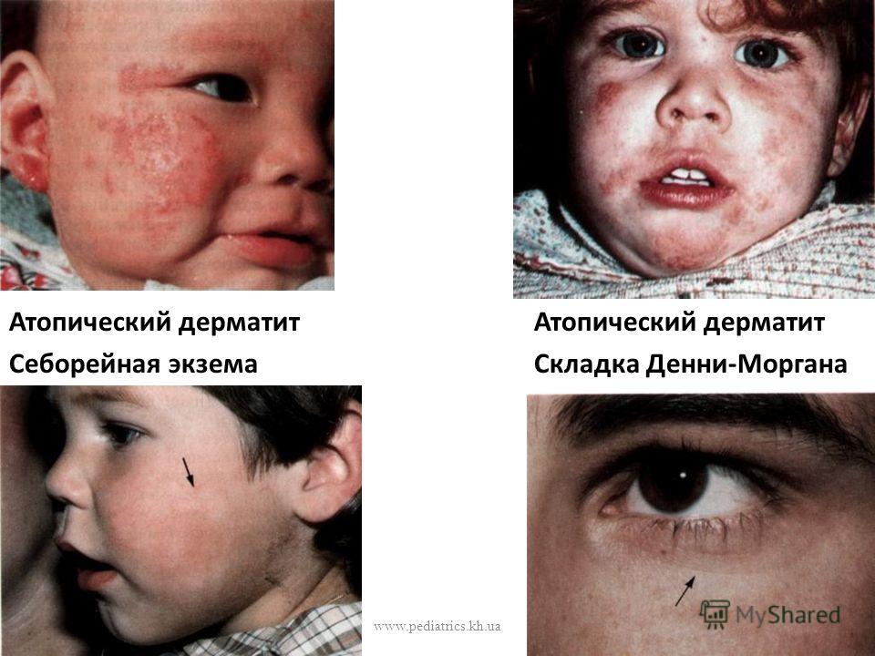 Какие травы можно пить при экземе