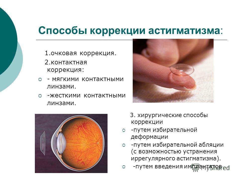 Линзы для коррекции астигматизма что это Линзы для коррекции астигматизма что это