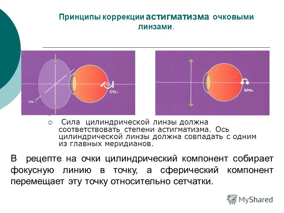 Линзы для коррекции астигматизма что это Линзы для коррекции астигматизма что это