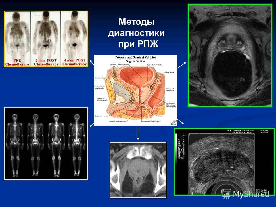 Влияет ли простатита на женское здоровье Витапрост (Vitaprostum) отзывы - Предстательная