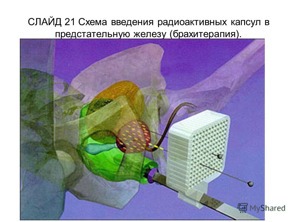 СЛАЙД 21 Схема введения радиоактивных капсул в предстательную железу (брахитерапия).