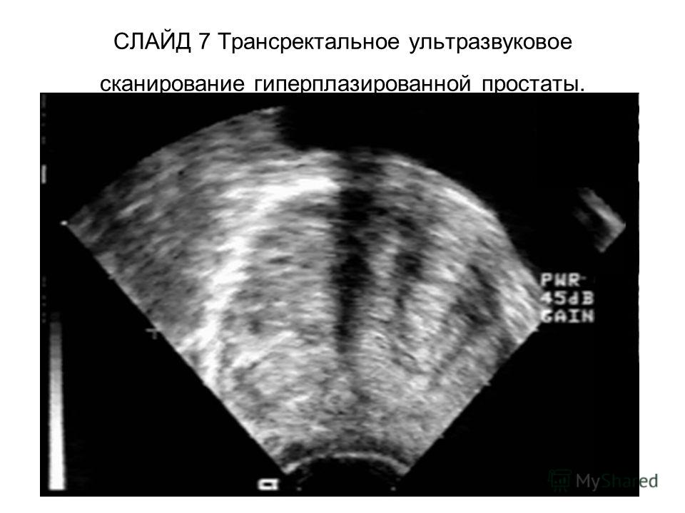 СЛАЙД 7 Трансректальное ультразвуковое сканирование гиперплазированной простаты.