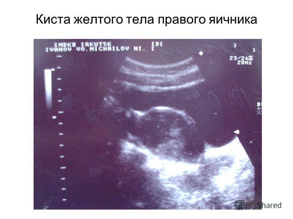 Беременость с кистой Беременость с кистой