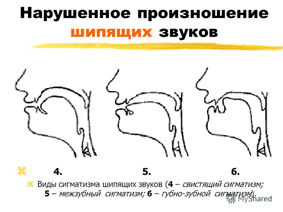 Межзубный сигматизм и его коррекция Межзубный сигматизм и его коррекция