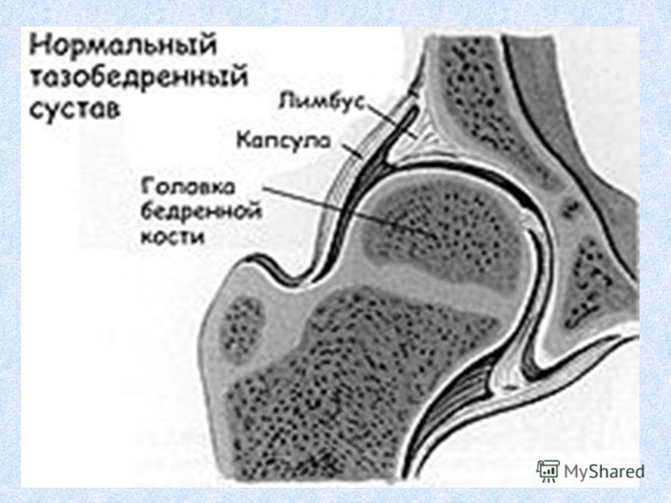 Лимбус в тазобедренном суставе это Лимбус в тазобедренном суставе это