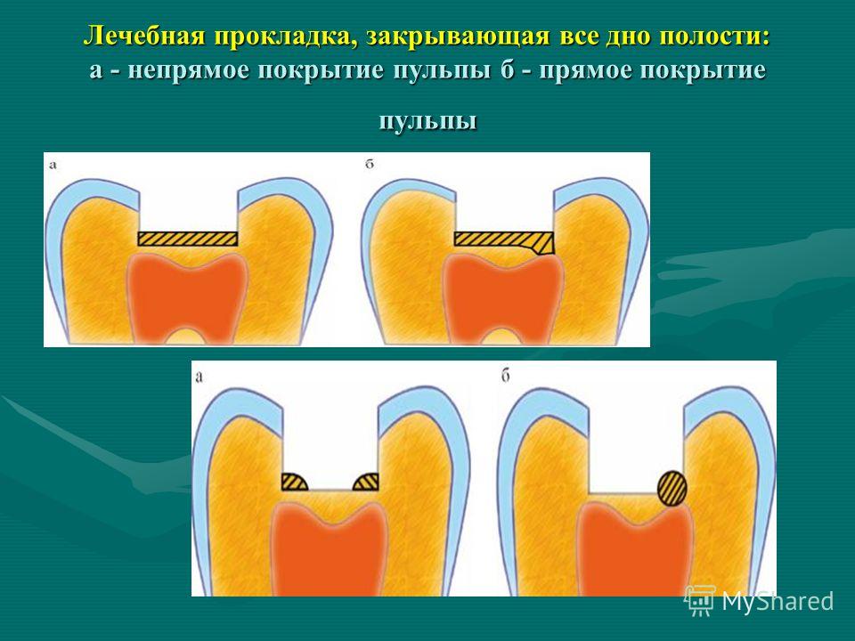 Подкладка на зуб для чего Подкладка на зуб для чего