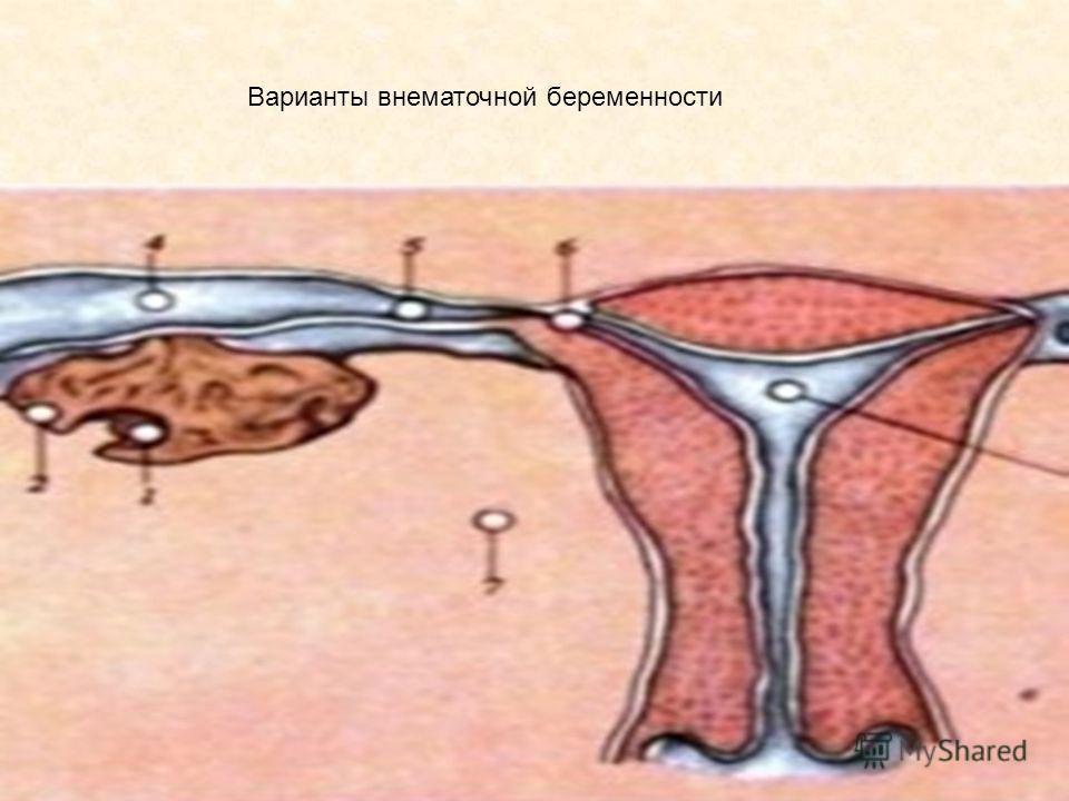 Диета После Внематочной