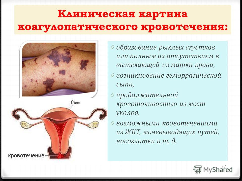 Может Быть Признаком Беременности Кровотичение Может Быть Признаком Беременности Кровотичение