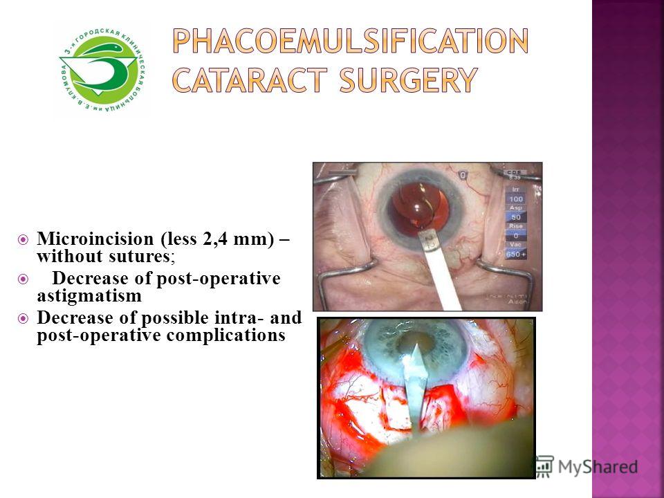 Microincision (less 2,4 mm) – without sutures; Decrease of post-operative astigmatism Decrease of possible intra- and post-operative complications