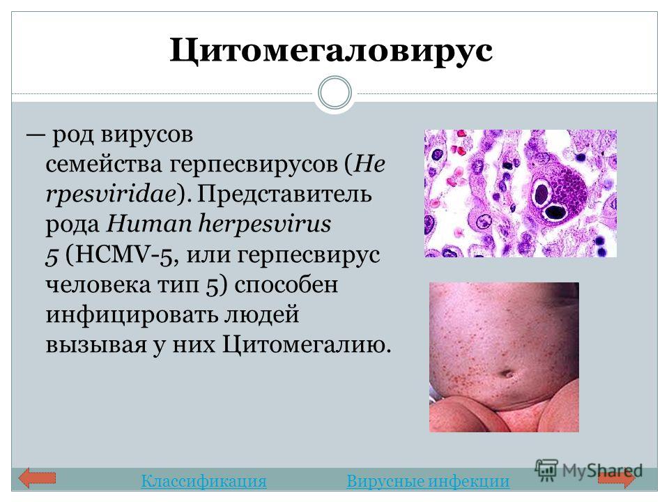 Цитомегаловирус род вирусов семейства герпесвирусов (He rpesviridae). Представитель рода Human herpesvirus 5 (HCMV-5, или герпесвирус человека тип 5) способен инфицировать людей вызывая у них Цитомегалию. КлассификацияВирусные инфекции