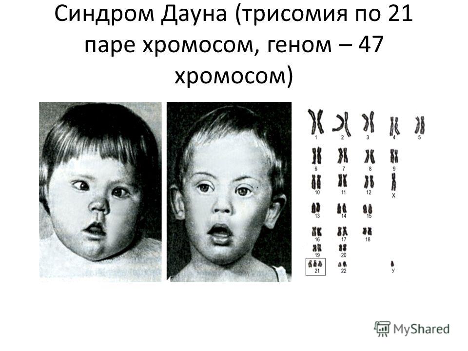 Синдром Дауна (трисомия по 21 паре хромосом, геном – 47 хромосом)