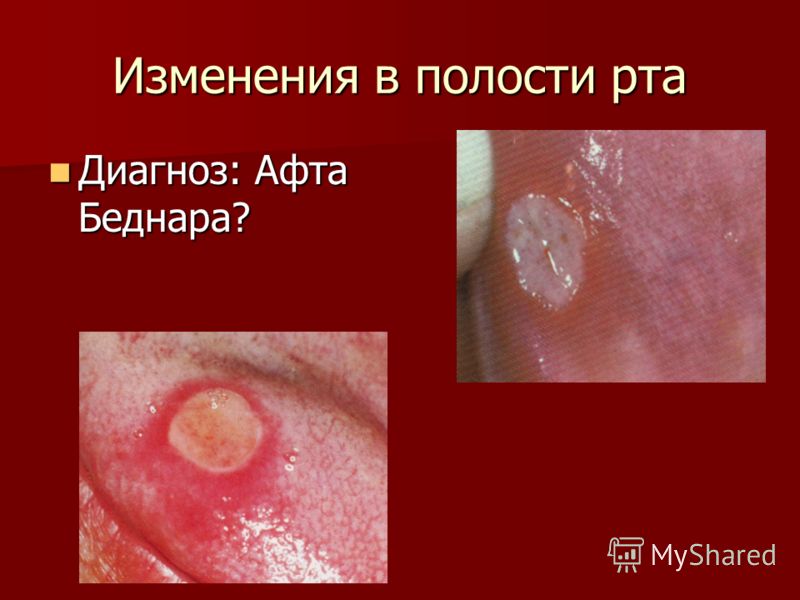 Как определить экзему на ногах