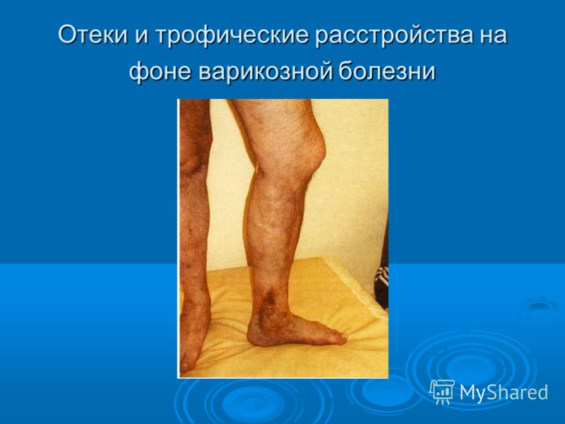 Воспалились вены на ногах болит что делать