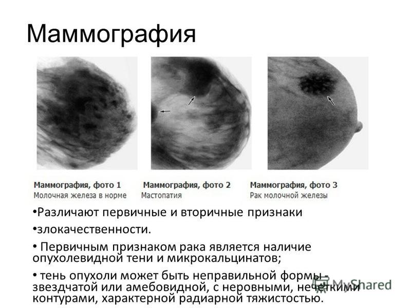 Как сделать узи молочной железы 158