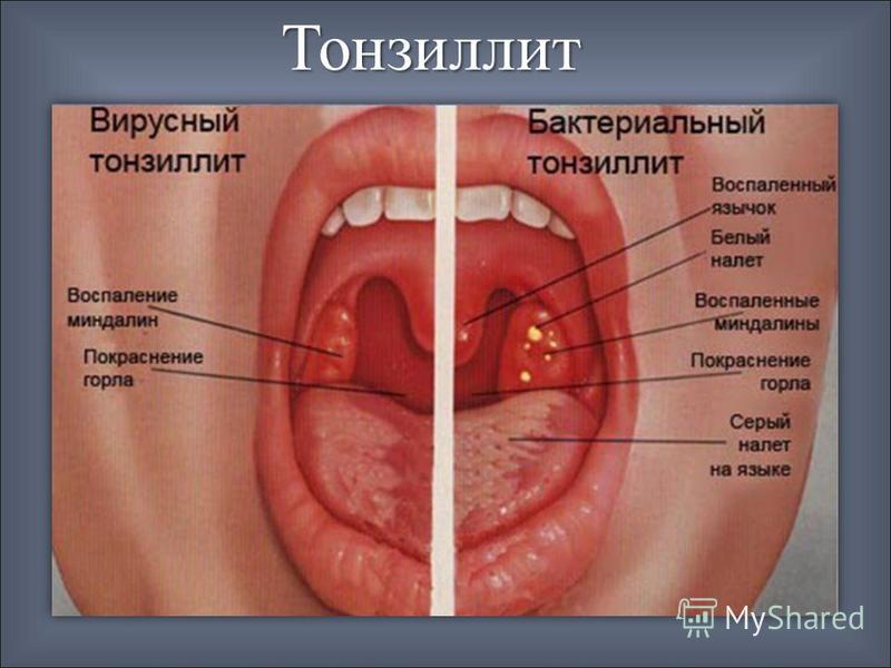 Прыщи на носоглотки что это такое Прыщи на носоглотки что это такое