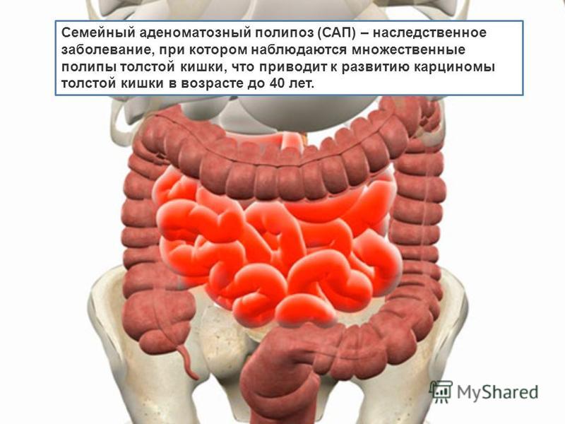 Как лечить воспаление прямой кишки народными средствами 54