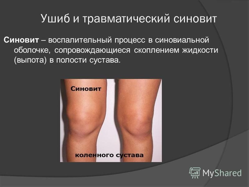 Лечение синовита коленного сустава в домашних условиях 655