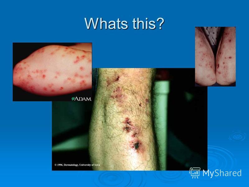 acne a very common skin disease Acne is a skin disease involving the oil glands at the base of hair follicles it affects 3 in every 4 people aged 11 to 30 years acne is a common skin problem. acne a very common skin disease Acne is a skin disease involving the oil glands at the base of hair follicles it affects 3 in every 4 people aged 11 to 30 years acne is a common skin problem.