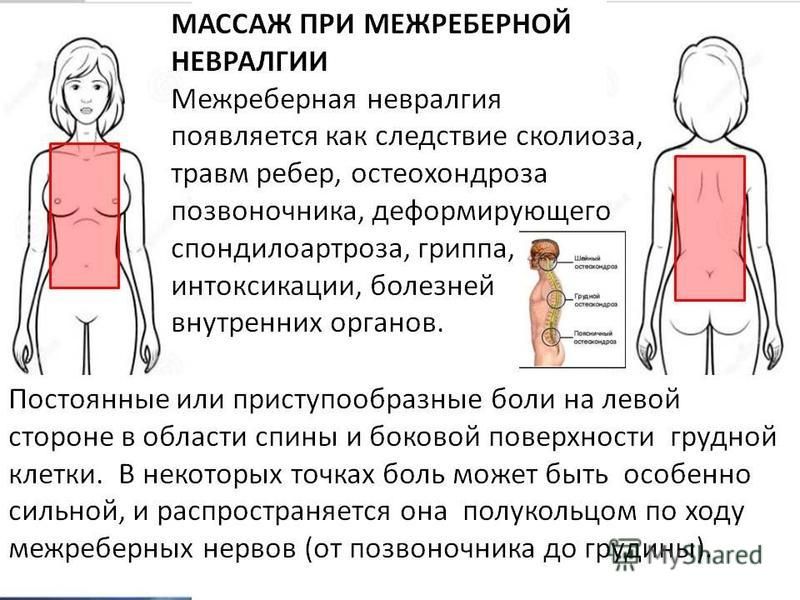 Межрёберная невралгия при беременности лечение в домашних условиях 691
