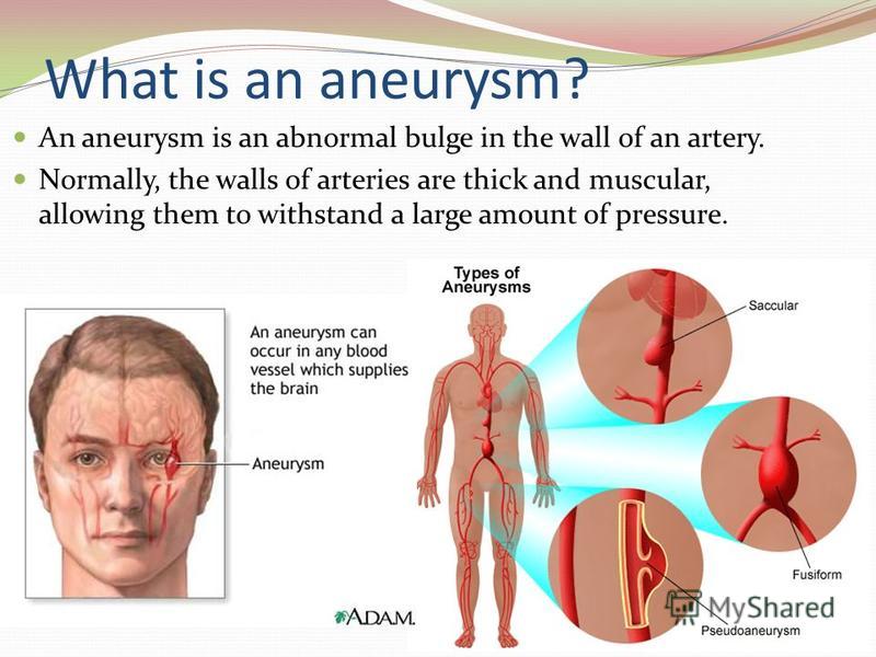 a description of brain aneurysm a bulge formed by the ballooning of the wall of an artery or a vein (brain aneurysm) varicose aneurysm one formed by rupture of an aneurysm into a vein saccular aneurysm sac-like ballooning of an artery wall aneurysm. a description of brain aneurysm a bulge formed by the ballooning of the wall of an artery or a vein (brain aneurysm) varicose aneurysm one formed by rupture of an aneurysm into a vein saccular aneurysm sac-like ballooning of an artery wall aneurysm.