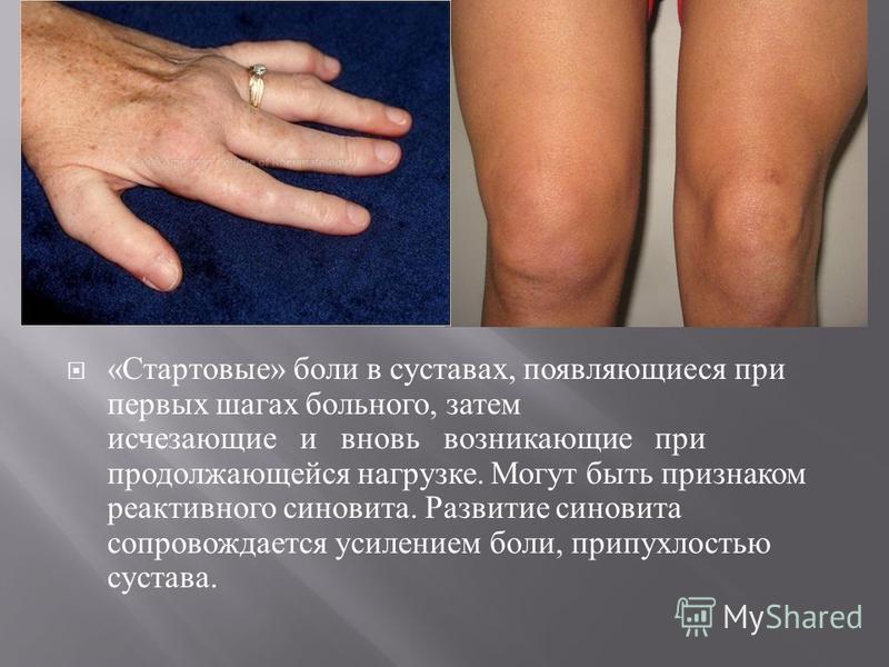 Припухлость сустава пальца руки. Основные повреждения связок кисти | Герммед КАК ВЫЛЕЧИТЬ СУСТАВЫ ПАЛЬЦЕВ РУК: УНИКАЛЬНЫЙ МЕТОД! | Артрит, Здоровье Хроническая тофусная подагра