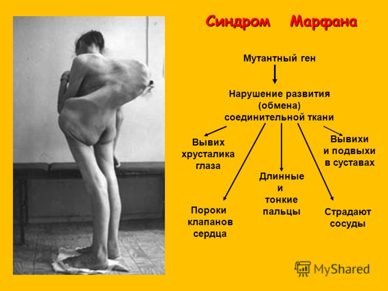 Синдром Марфана - Причины, симптомы и лечение. Журнал 62 Синдром Марфана - Причины, симптомы и лечение. Журнал 59