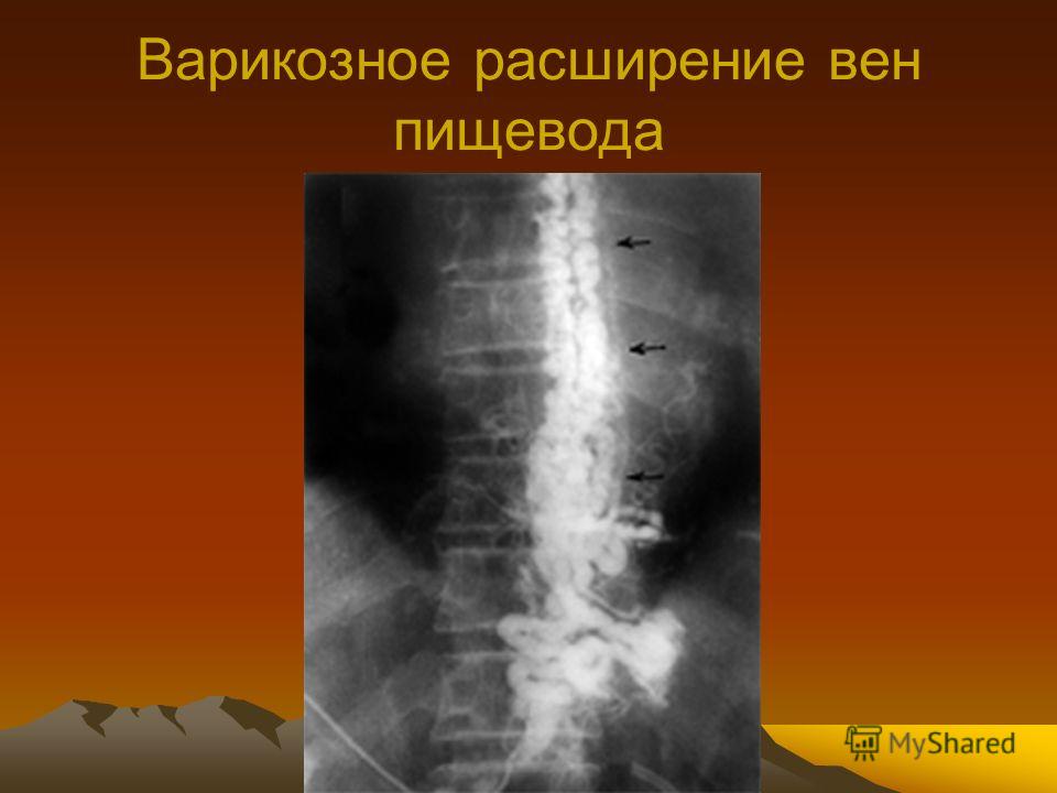 Болит спина и ноги лечение народными средствами