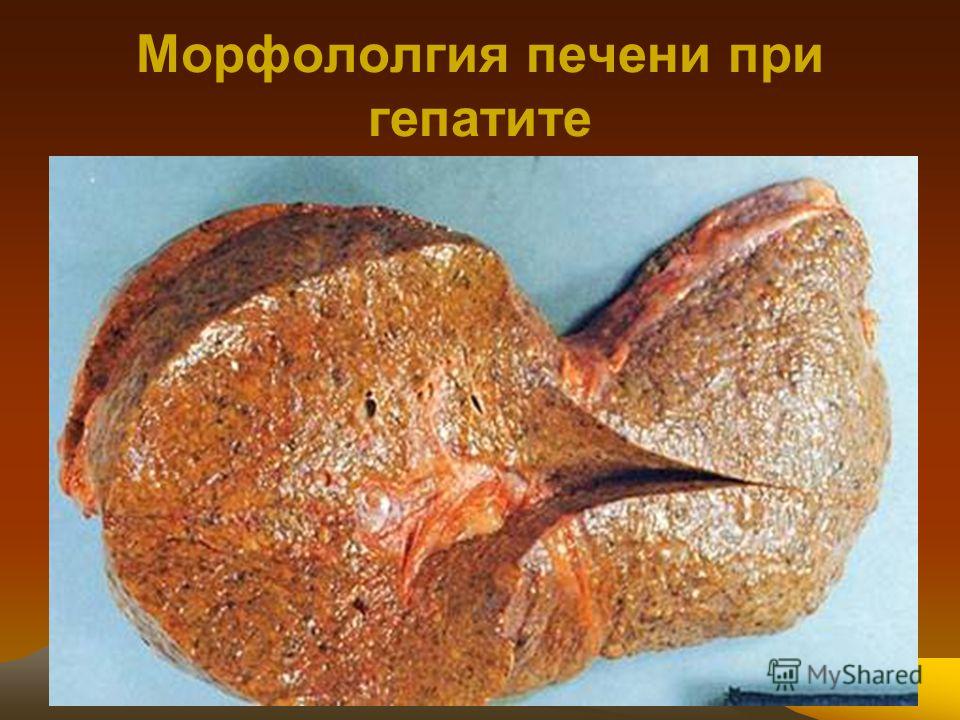 Фото больных детей гепатитом Фото больных детей гепатитом
