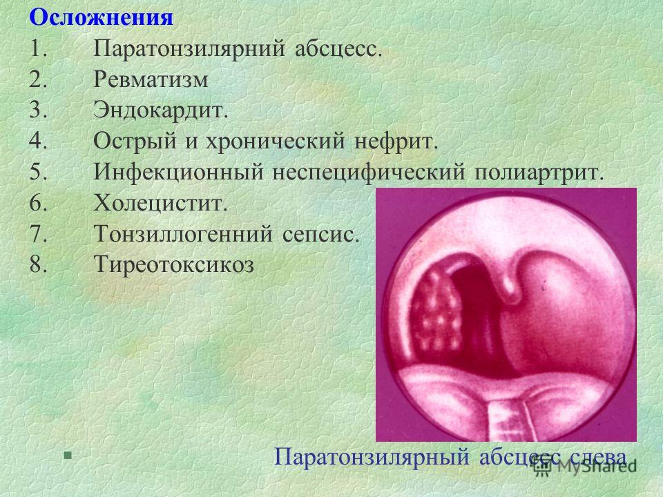 запах изо рта тонзиллит что делать запах изо рта тонзиллит что делать