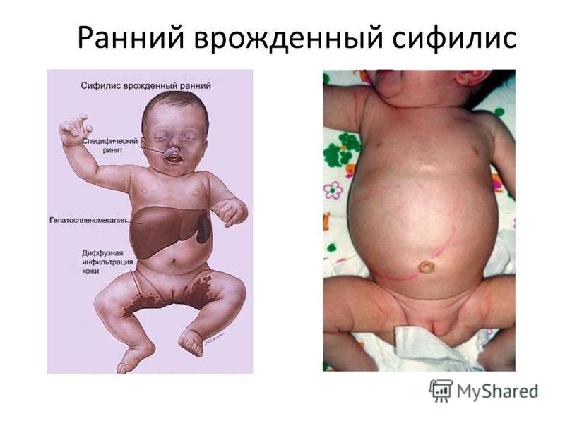 фото врожденный сифилис онлайн фото врожденный сифилис