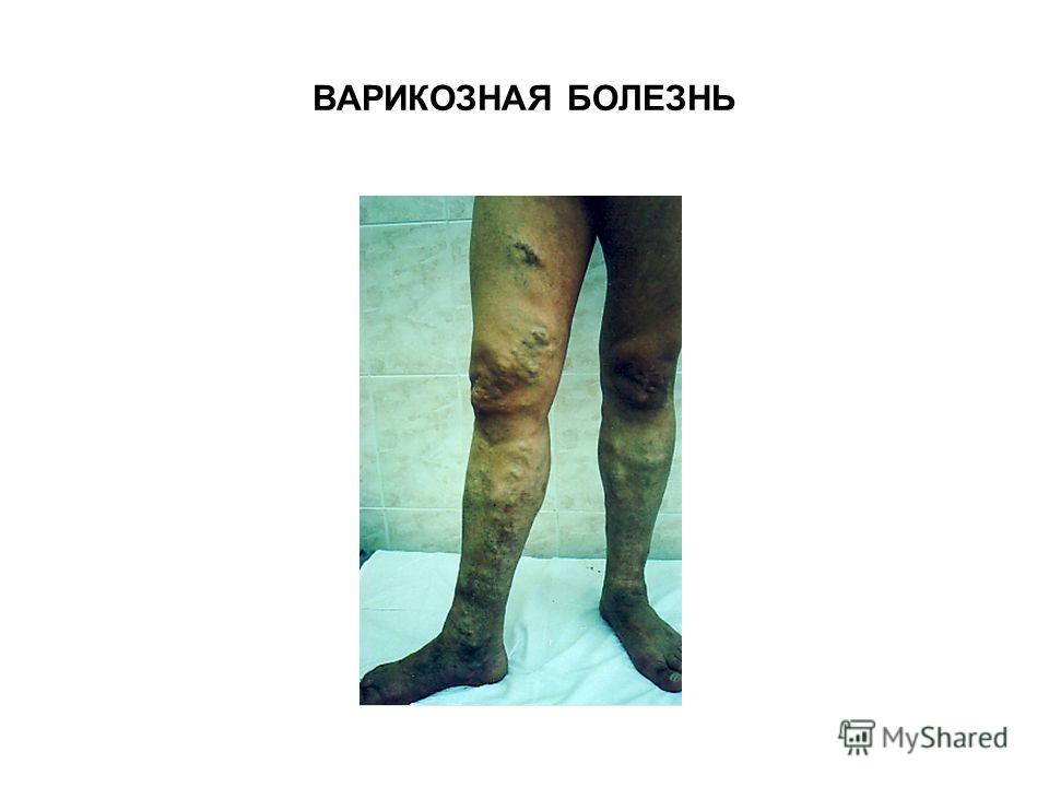 Варикоз почему чешутся вены