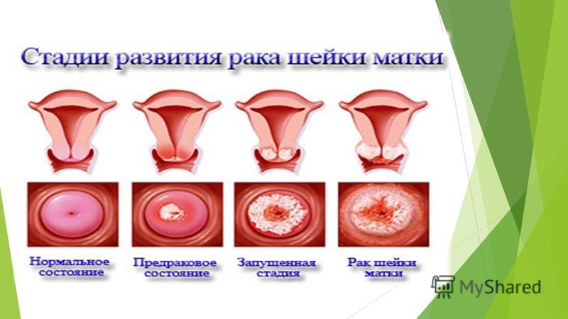 Начинающий рак шейки матки как выглядит