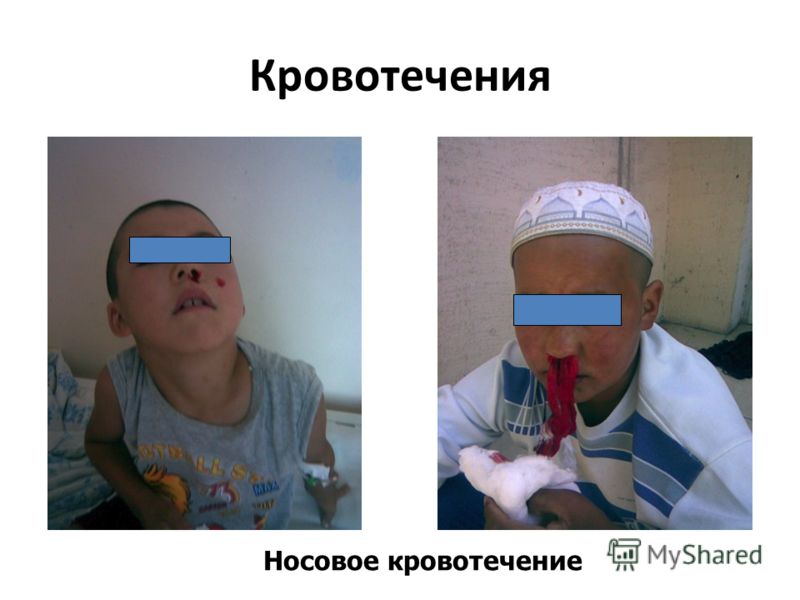 Формальдегид Википедия Вирус Коксаки найден в 2017 году в отелях Турции