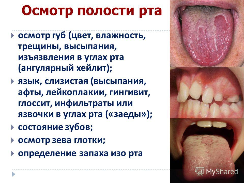 запах изо рта при грыже пищевода запах изо рта при грыже пищевода