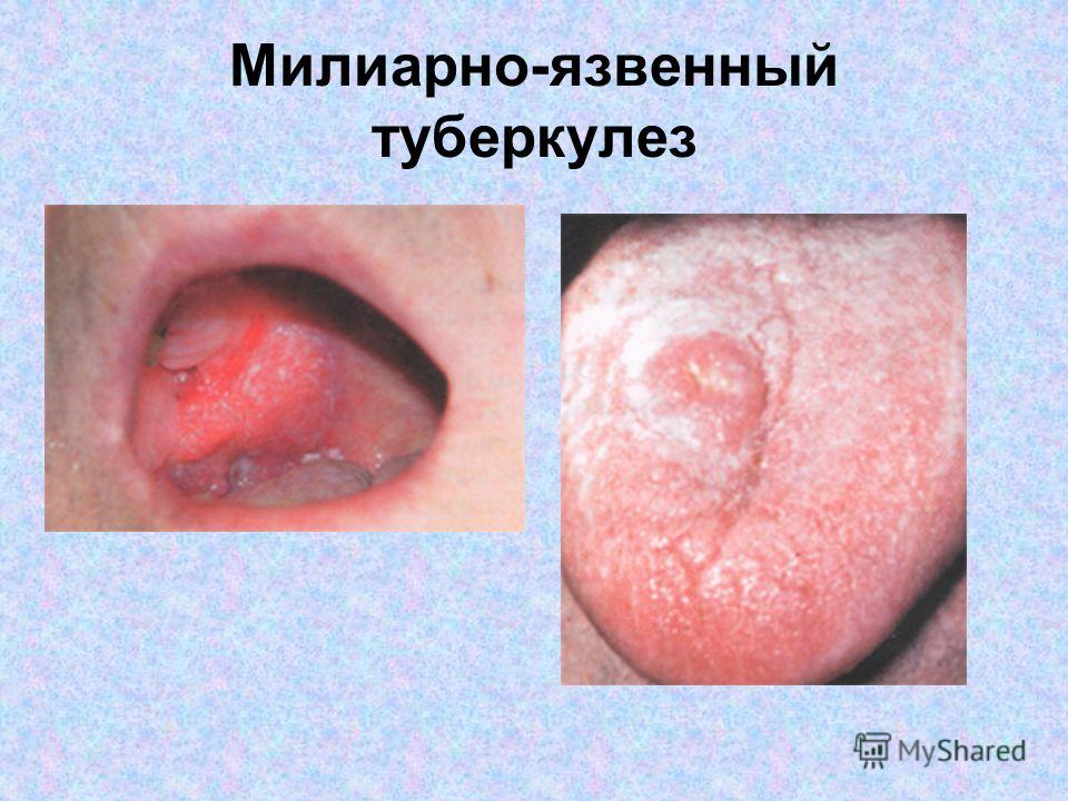 Язвенный туберкулез кожи Язвенный туберкулез кожи