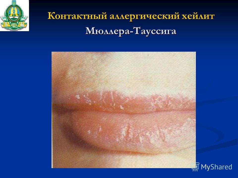 Чем питаться при нейродермите