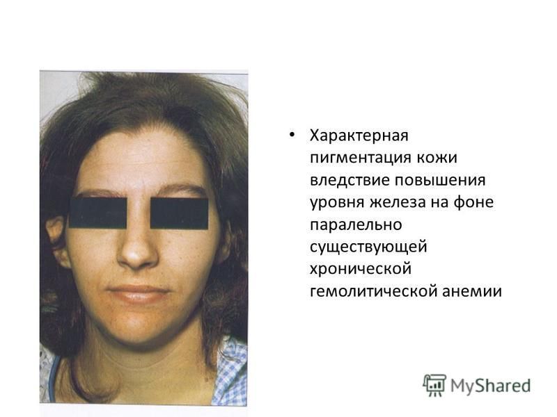 Как выглядит кожа при анемии Презентация на тему: "ГЕМОЛИТИЧЕСКИЕ И АУТОИММУННЫЕ АНЕМИИ. Гемолитическая анеми