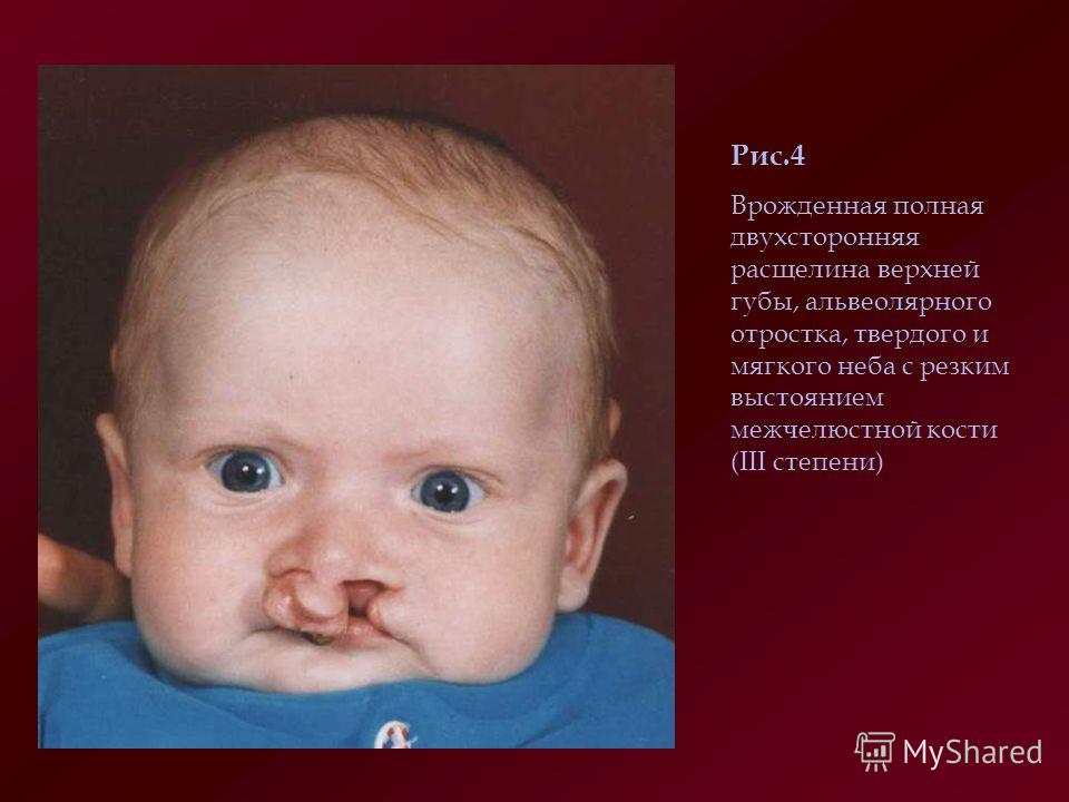 расщелина верхней губы и неба фото онлайн расщелина верхней губы и неба фото