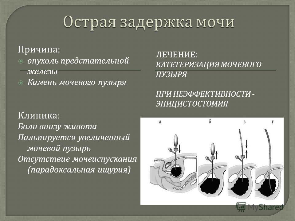 Острая задержка мочи при аденоме простаты Острая задержка мочи при аденоме простаты