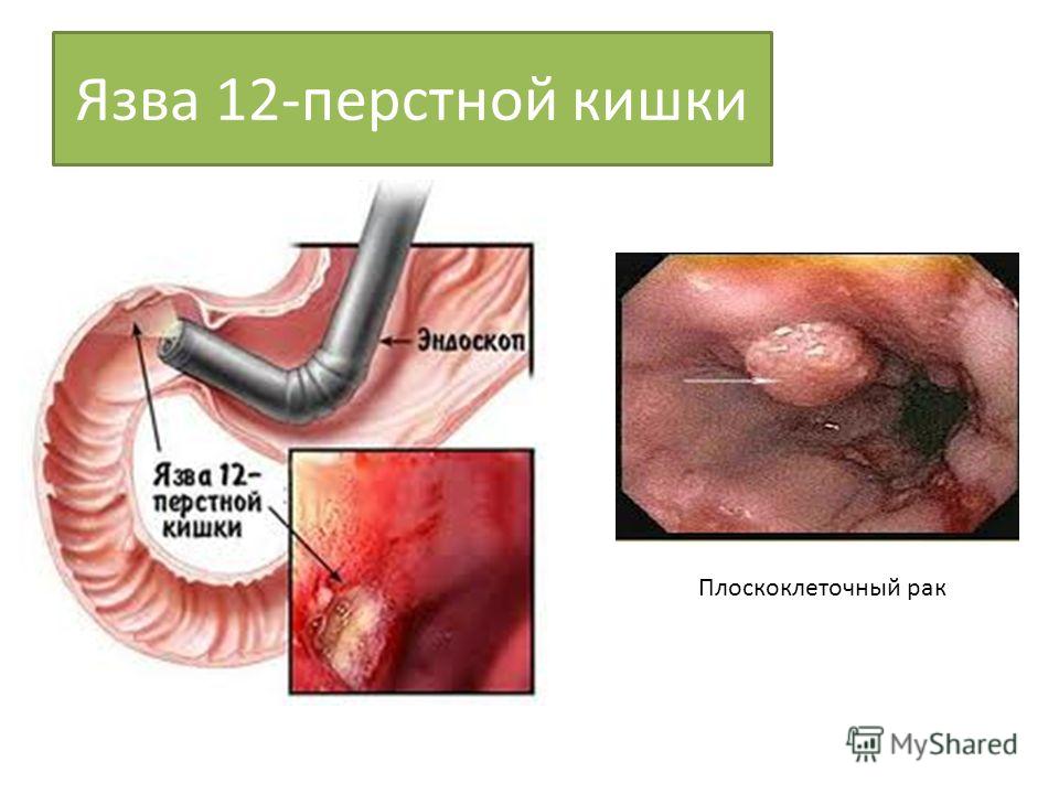 Как лечить 12 перстную кишку и язву желудка Как лечить 12 перстную кишку и язву желудка
