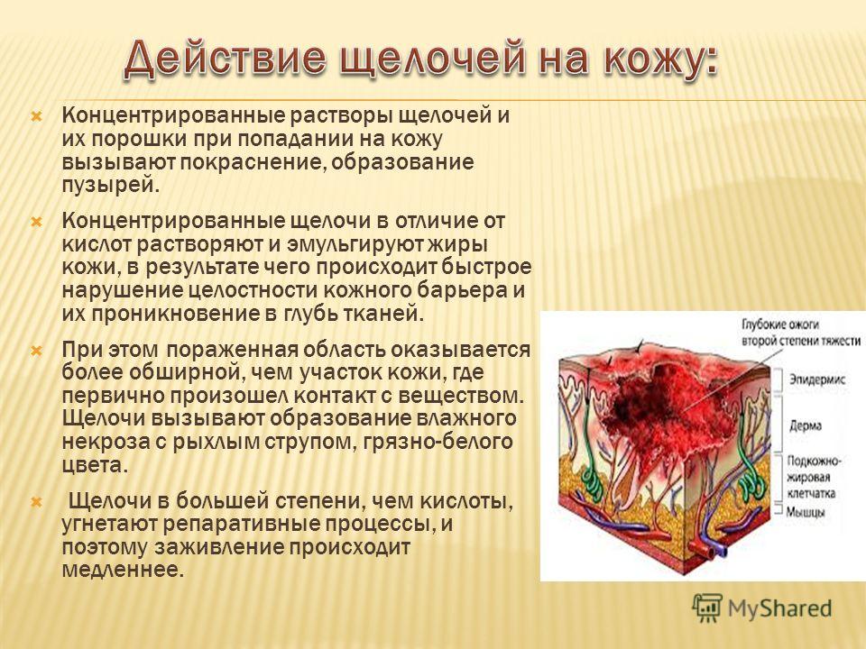 Попадание каустика на коже Попадание каустика на коже
