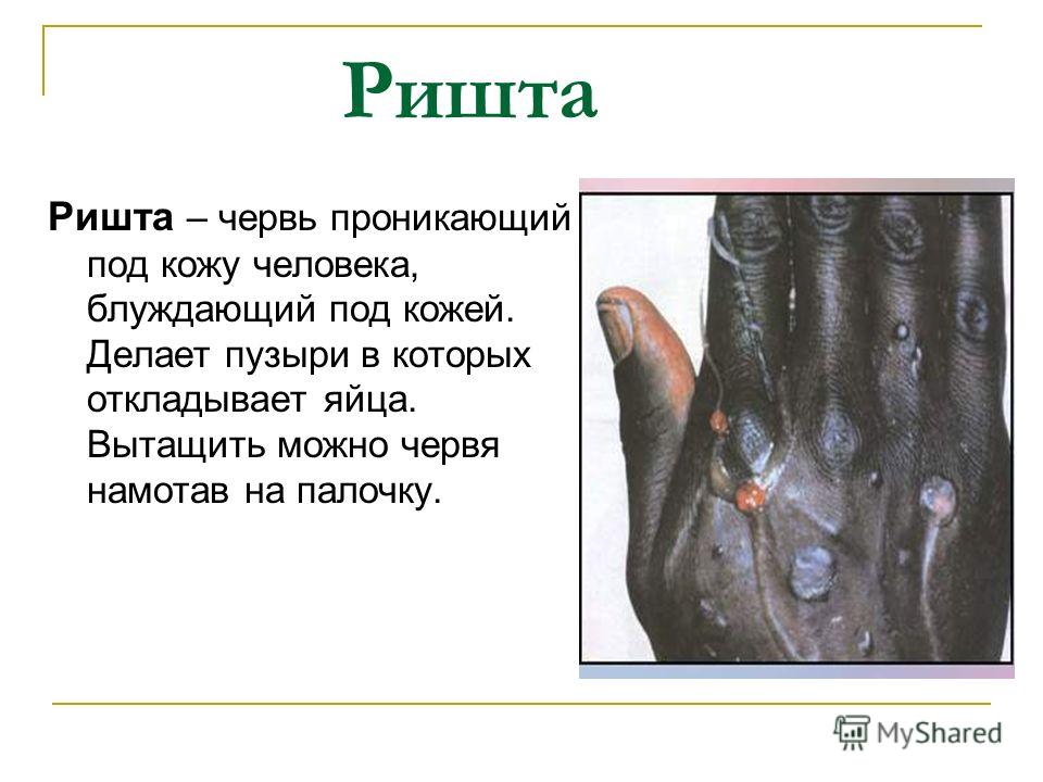 Болезнь при которой из кожи личинки Болезнь при которой из кожи личинки