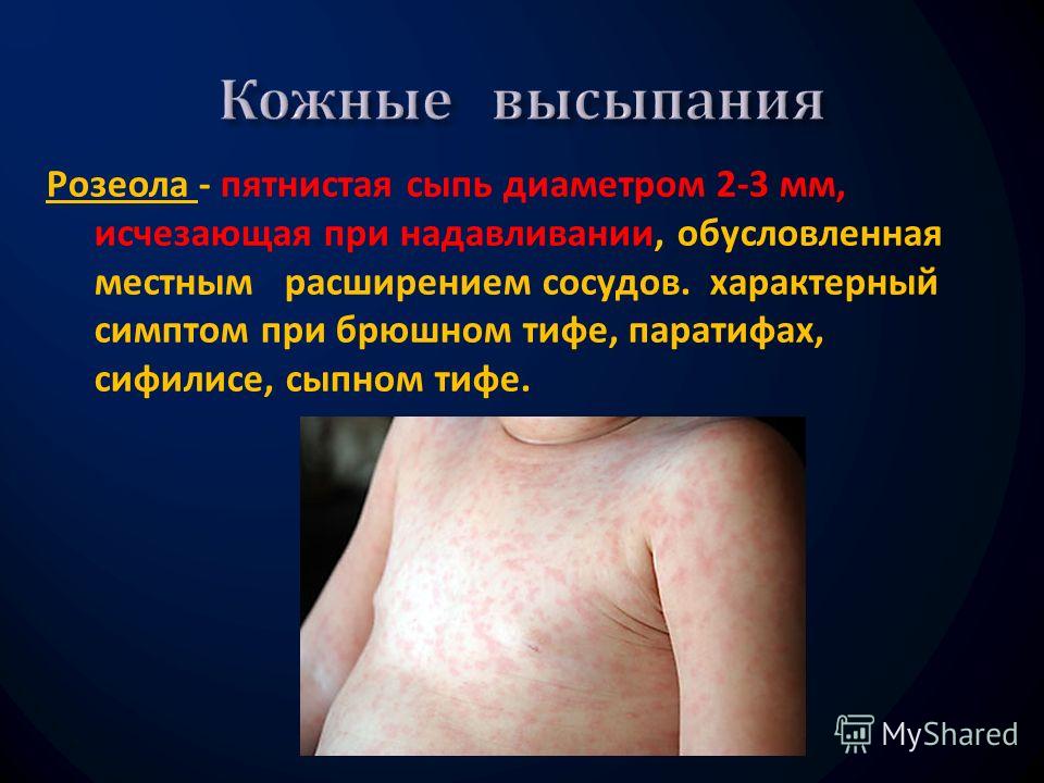 Розеолезная сыпь при брюшном тифе Розеолезная сыпь при брюшном тифе