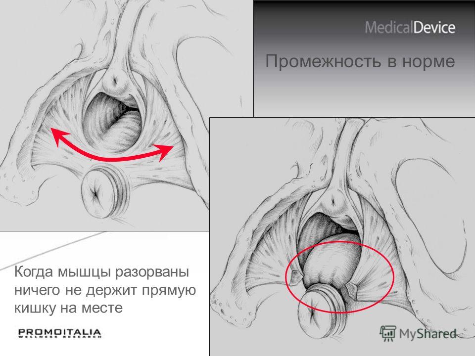 Сужение влагалища спринцеванием Из Вконтакте