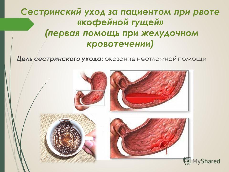 Уход за больным при кишечной непроходимости Уход за больным при кишечной непроходимости