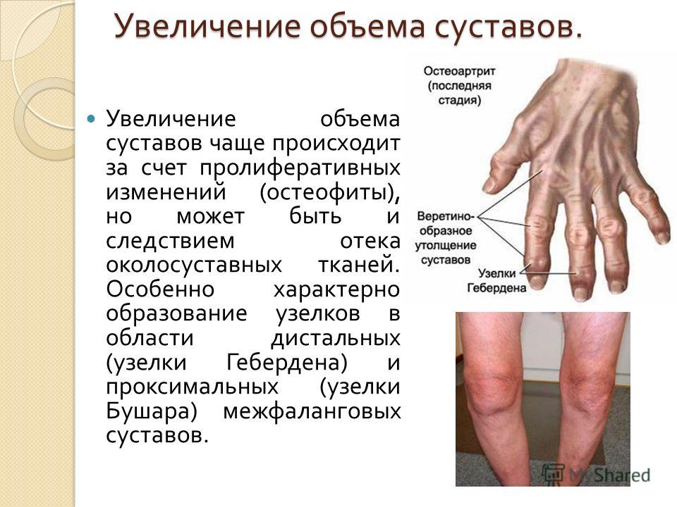 Остеоартроз грудного отдела позвоночника симптомы. Межпозвоночная грыжа Грыжа грудного отдела позвоночника - симптомы и лечение | клиника. Лечение межпозвоночной грыжи - Медцентр "Диагност" - Благовещенск