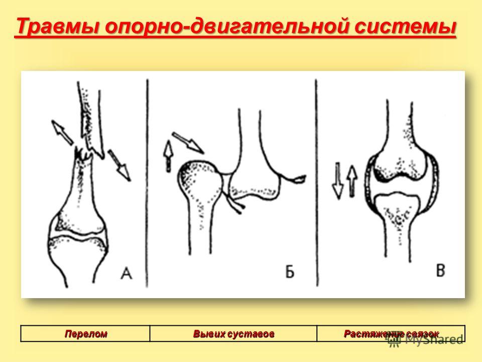 Первая медицинская помощь суставы и кости вывехи и переломы анализ крови при суставах