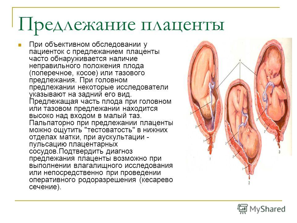 predlezhanie-platsenti-seks predlezhanie-platsenti-seks