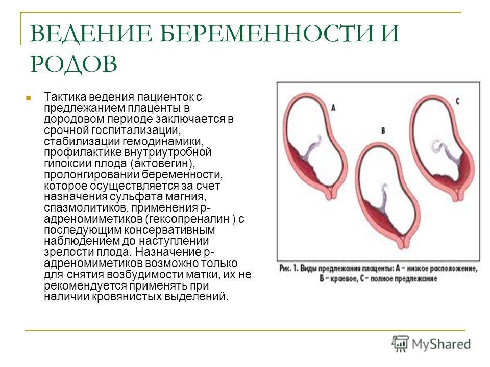 Предлежание плаценты отзывы беременных 89