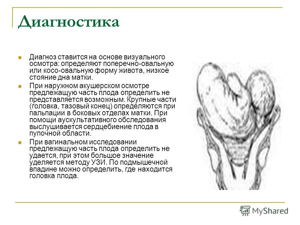 Диагноз крупный плод при беременности